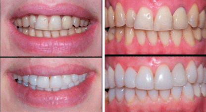 Teeth Whitening Toothpaste